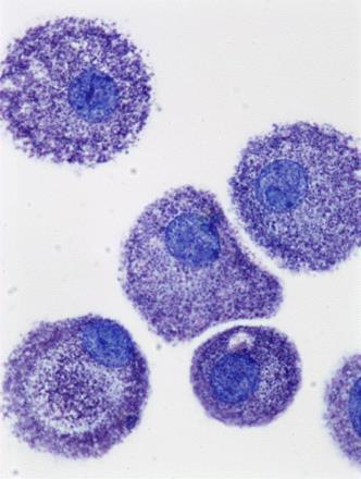 Mastocytose/ Systemisk mastocytose (SM) De vanligste problemer, symptomer og behandlingsformer Ingunn