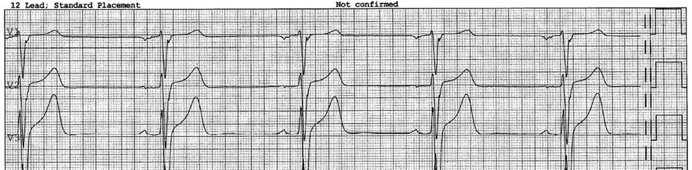 Figur 3. Typisk EKG frå mannleg pasient med moderat Fabry kardiomyopati (same pasient som figur 1, A).
