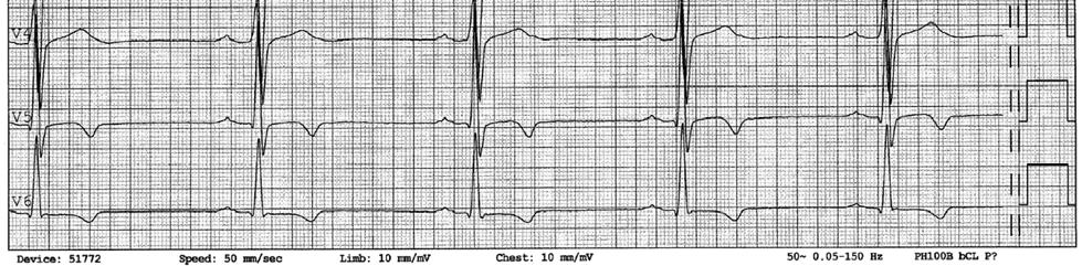 Behandling med enzymsubstitusjon (ERT) Enzymsubstitusjonsbehandling (Enzyme Replacement Therapy ERT) har vore tilgjengeleg sidan 2001.