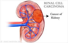 Treatment of Renal Cell Carcinoma: From Mice to Men!