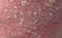 important to pathogenesis of psoriasis 2000 s Psoriasis is a