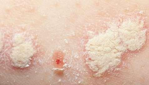 diagnosen: Psoriasis hos barn Begynnende Overgangsformer