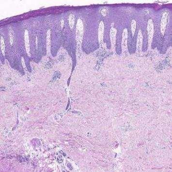 normal hud psoriasis