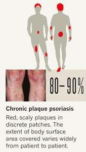 psoriasis med