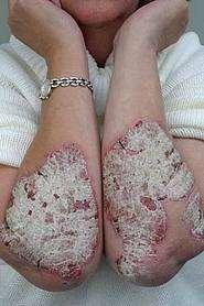 Guttat psoriasis