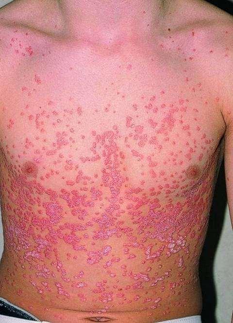 Guttat psoriasis (gutta =