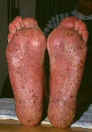 Sterile pustler lokalisert i håndflater og fotsåler.