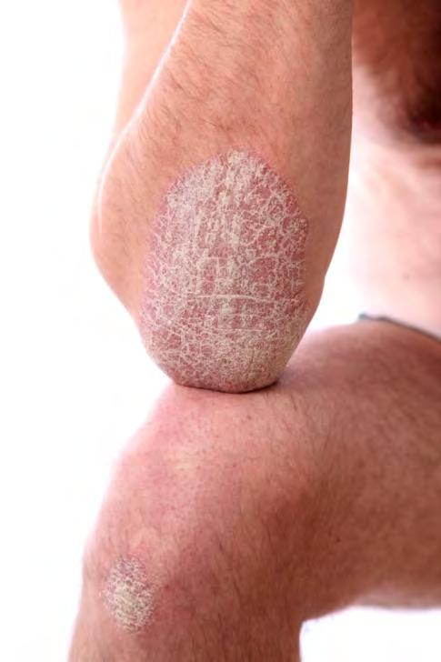 Psoriasis - bakgrunn Kronisk inflammatorisk hudsykdom Økt turnover i epidermis Multifaktoriell, 66-68% genetisk betinget Prevalens varierer avhengig av etnisitet og geografisk