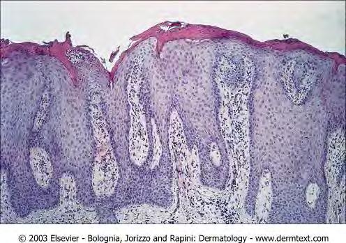 Psoriasis under overflaten Ny hud dannes på rekordtid; 4