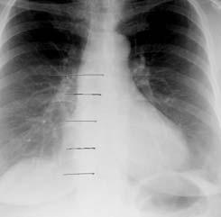 Carina: Delingspunktet av trachea i hø. og ve.