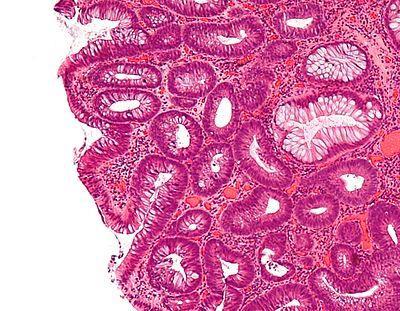 1. Konvensjonelle adenomer Histologisk lavgradig dysplasi - Tett kjertelbilde, dels rygg mot rygg, men ingen kribriformt vekst - forstørrete, langstrakte