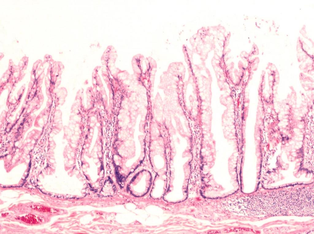 2. Sagtaggete polypper 2.2. Bredbasede sagtaggete polypper (WHO «classification of tumors of the digestive