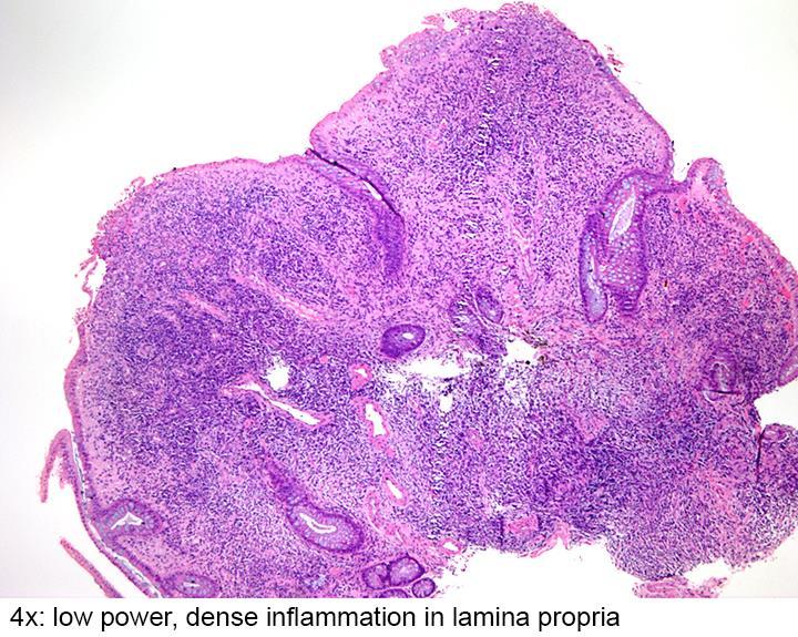 Inflammatorisk polypp