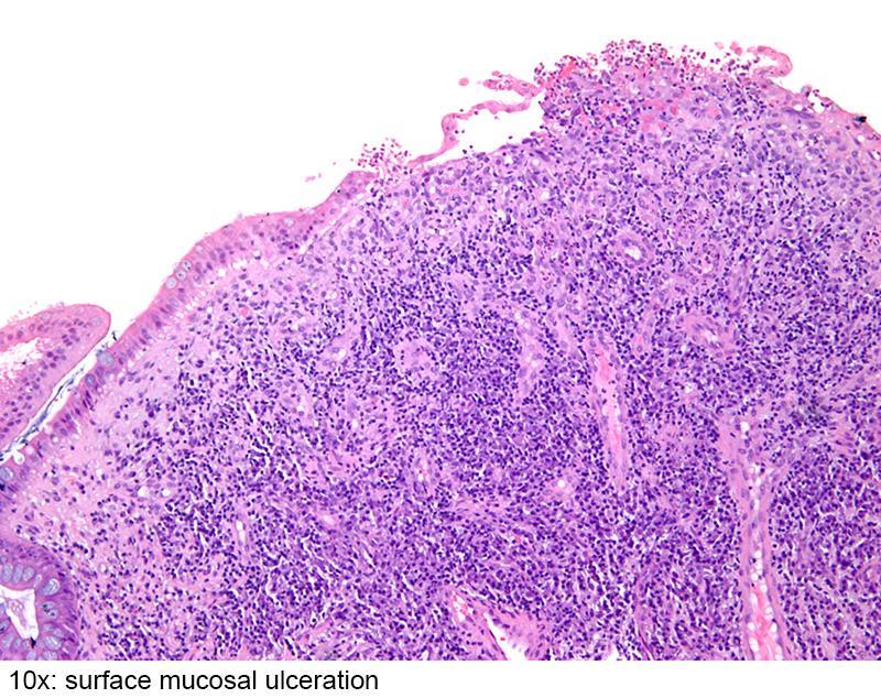 Inflammatorisk polypp