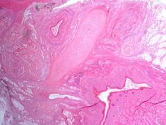 Plateepitelkledd dilatert gang sylindrisk epitel Keratinisering Sjeldnere sylindrisk