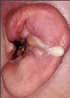 Nekrotiserende ekstern otitt (Malign otitis externa) Aggressiv form av otitt forårsaket av Pseudomonas aeruginosa