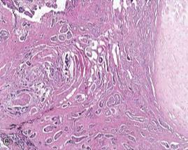 adenokarsinom Malign tumor utgående fra cerumenproduserende apokrine kjertler i ytre øregang Ceruminøst adenom