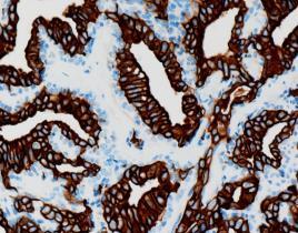 neutrofile granulocytter Reaktiv proliferasjon av kar 14 Neoplastiske lesjoner: ytre øre Ceruminøse tumores benigne