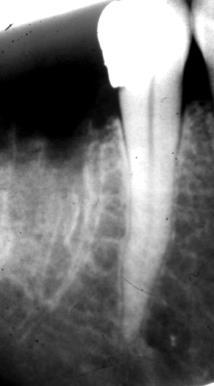 Infected pulp; apical periodontitis Instrumentation & irrigation Dressing Infected pulp; apical periodontitis Instrumentation & irrigation