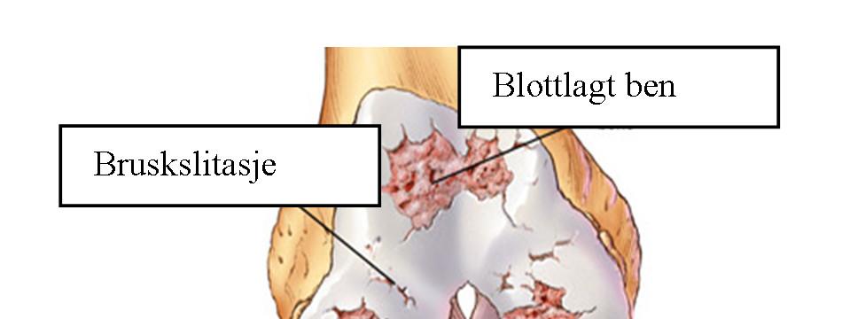 TOTALPROTESE I KNE Kneprotese blir se inn e er stor slitasje på leddbrusken i kneet.