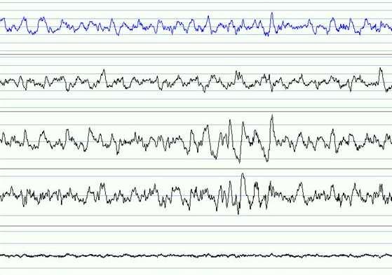 Stadie 3 og 4 EOG Omtrent ingen EEG Lav frekvens og høy amplitude bølger (delta