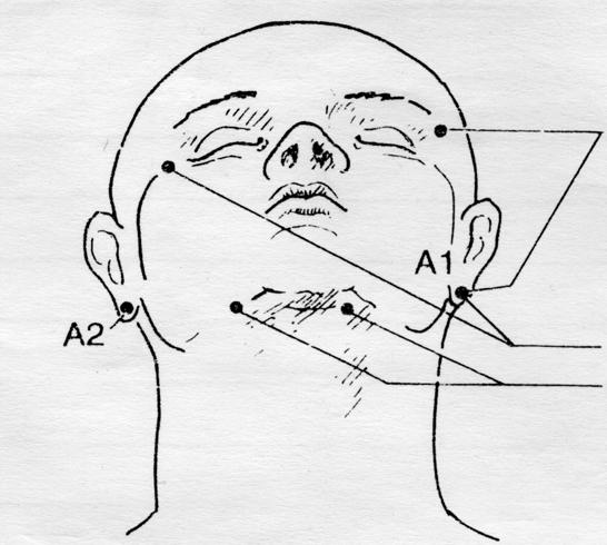 Elektroencephalogram (EEG) EEG måler samlet nervronalt aktivitet i området under elektroden