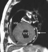 ventrikkel (18). Ved restriktiv kardiomyopati vil MRs viktigste bidrag være å utelukke konstriktiv perikarditt; ved førstnevnte tilstand er perikard normal, ved sistnevnte fortykket (minst 4 mm).