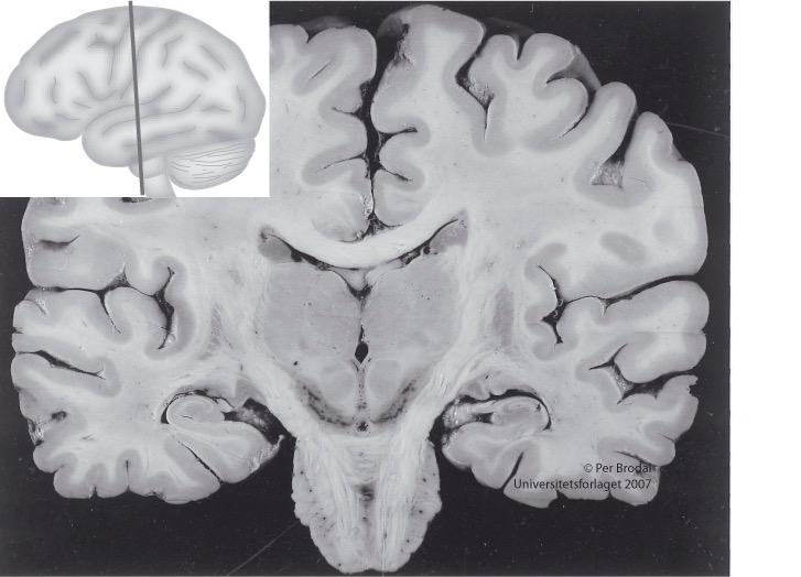 Thalamus og cortex cerebri Corpus callosum Nucleus caudatus Fornix Thalamus 3.