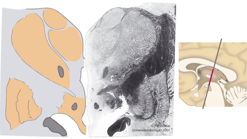 Thalamus (frontalsnitt) Nucleus anterior Lamina medullaris interna Nucleus medialis Nucleus lateralis Capsula interna Fasciculus mamillothalamicus