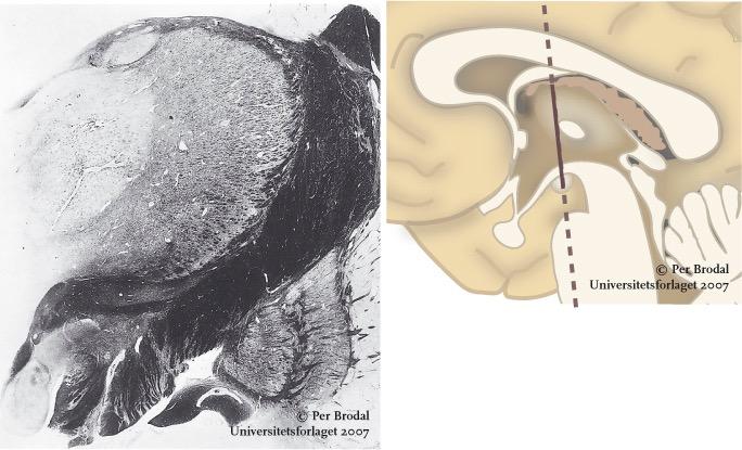 Thalamus (frontalsnitt) Thalamus Nucleus anterior Nucleus lateralis dorsalis (LD) Nucleus medialis dorsalis (MD) Nucleus reticularis thalami Nucleus ventralis lateralis