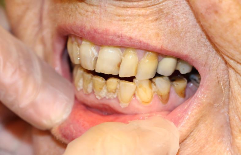 Viktige observasjoner hos alle pasienter. Observer munnmotorikk og svelgeevne. Nedsatt munnmotorikk og svelgeevne kan ses ved mange sykdommer og tilstander.