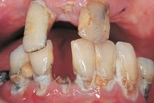 1. Pasienter som klarer munn og tannstellet selv: Mål Opprettholde god munnhygiene slik at sykdom i tenner og tannkjøtt ikke oppstår. Utstyr Liten myk tannbørste (evt.