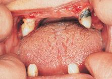 2. Pasienter med egne tenner som trenger hjelp til munn og tannstell: Mål Opprettholde god munnhygiene slik at sykdom i tenner og tannkjøtt ikke oppstår.