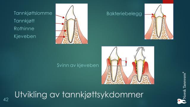 Tannkjøttbetennelse (Gingivitt) Dersom tennene ikke blir pusset daglig, vil bakteriebelegget langs tannkjøttskanten føre til en betennelse.
