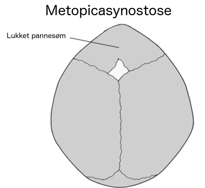 METOPICASYNOSTOSE Metopicasynostose, også kalt trigonocephali, er en av flere typer kraniosynostoser.