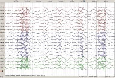 Anfall som ikke er epileptiske Kan være