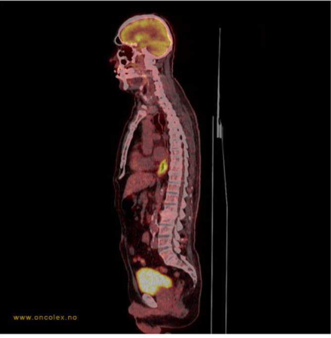 PET CT Positronemisjonstomografi + CT. Radioaktivitet. Nye «tracere», mange muligheter. Lesjoner > 0,5cm. Fysiologiske bilder; viser aktivitet i vevet.