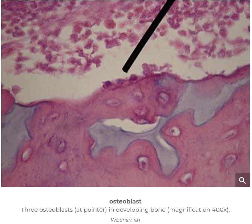 Osteosklerose (osteoblastiske) dominerer der det skjer en økt produksjon av osteoblaststimulerende faktorer lokalt rundt metastasen.