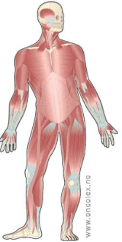 Sarkomer Primære maligne svulster i muskel, skjelett, fettvev, blodårer, perifere nerver, hud, tarmvev, bukhule, underhud, livmor og annet bindevev. Sjeldne. Noen tilfeldig oppdaget.