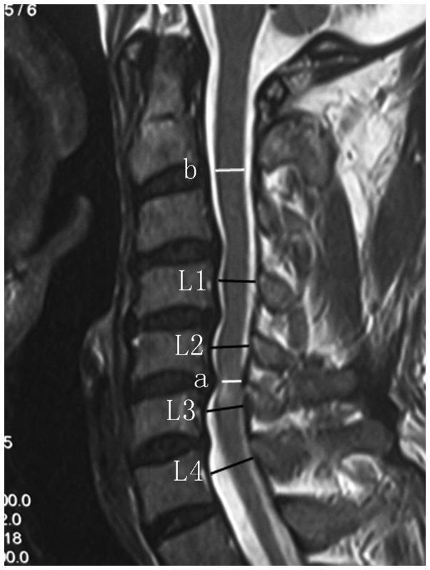 Cervikal myelopati: en underdiagnostisert årsak til fall og gangforstyrrelser?