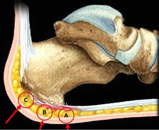 3. BMT og Plantarfasciitt Patomekanikk: Betennelse i aponeurosis plantaris kjennetegnes med smerter når du går, smerten er lokalisert til under hælen i forkant.