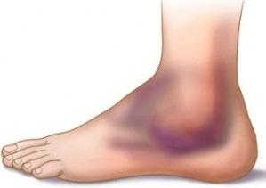 Operasjoner i fot og ankel vil føre l hevelse som varer minst 8 uker. Du bør ikke si e med foten ned, eller stå lenge, da det kan føre l økt hevelse, blødning og smerter.