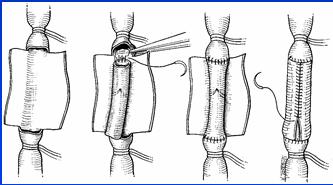 patients with primary chronic venous insufficiency Rosales et al.