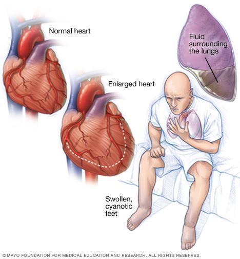 Symptomer på hjertesvikt Tungust Ortopnø (intoleranse å ligge flat)