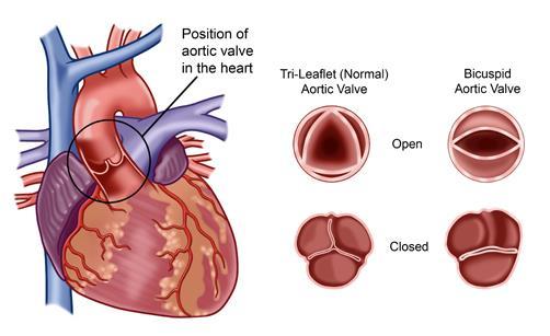 Klaffefeil (1) Aortastenose for trang aortaklaff, hyppig hos eldre,