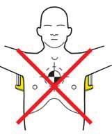 Når trykkputen i sugekoppen står i riktig posisjon, skal nedre kant av sugekoppen stå rett over enden av brystbenet. 9. Stopp den manuelle hjertekompresjonen. 10.