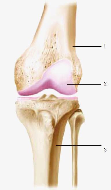 BAKGRUNN FOR KNEPROTESEKIRURGI Artrose Artrose er en degenerativ leddsykdom som kjennetegnes av nedbrytning av leddbrusk.