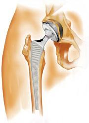 Hofteprotese Det finnes forskjellige typer proteser. Hofteprotesen består av en stamme, en leddkule og en kopp.