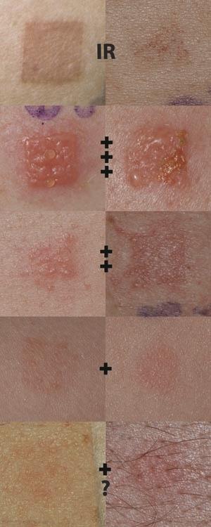 Foto: Chemotechnique Avlesning IR Irritant Reaction - Discrete patchy erythema without infiltration +++ Extreme positive reaction - Coalescing vesicles - Bullous or ulcerative reaction ++ Strong
