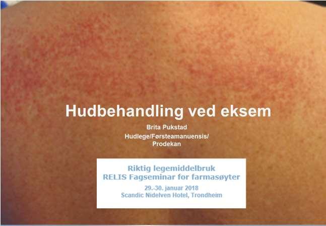 Agenda Huden som Tørr hud og kløe Eksem Behandling Fuktighetsbevarende behandling Bad og omslag Topikale steroider Våtbandasjer (WetWrap) 1 2 Huden som Lipidfilm ceramider, cholesterol, frie